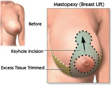 Breast Cosmetic